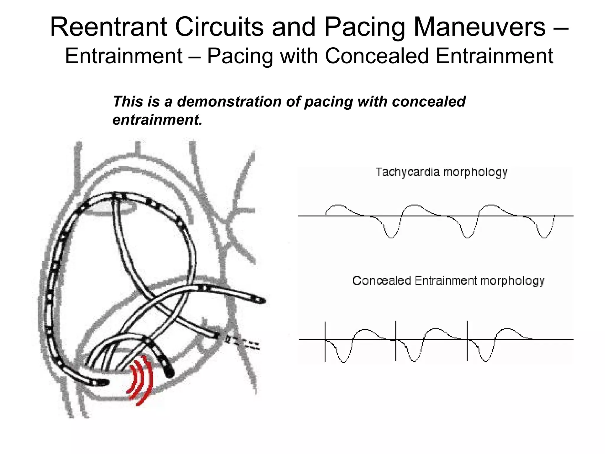 Reentrant Circuits and Pacing Maneuvers –
       Entrainment – Pacing with Concealed Entrainment
           This is a demonstration of pacing with concealed
           entrainment.




116
 