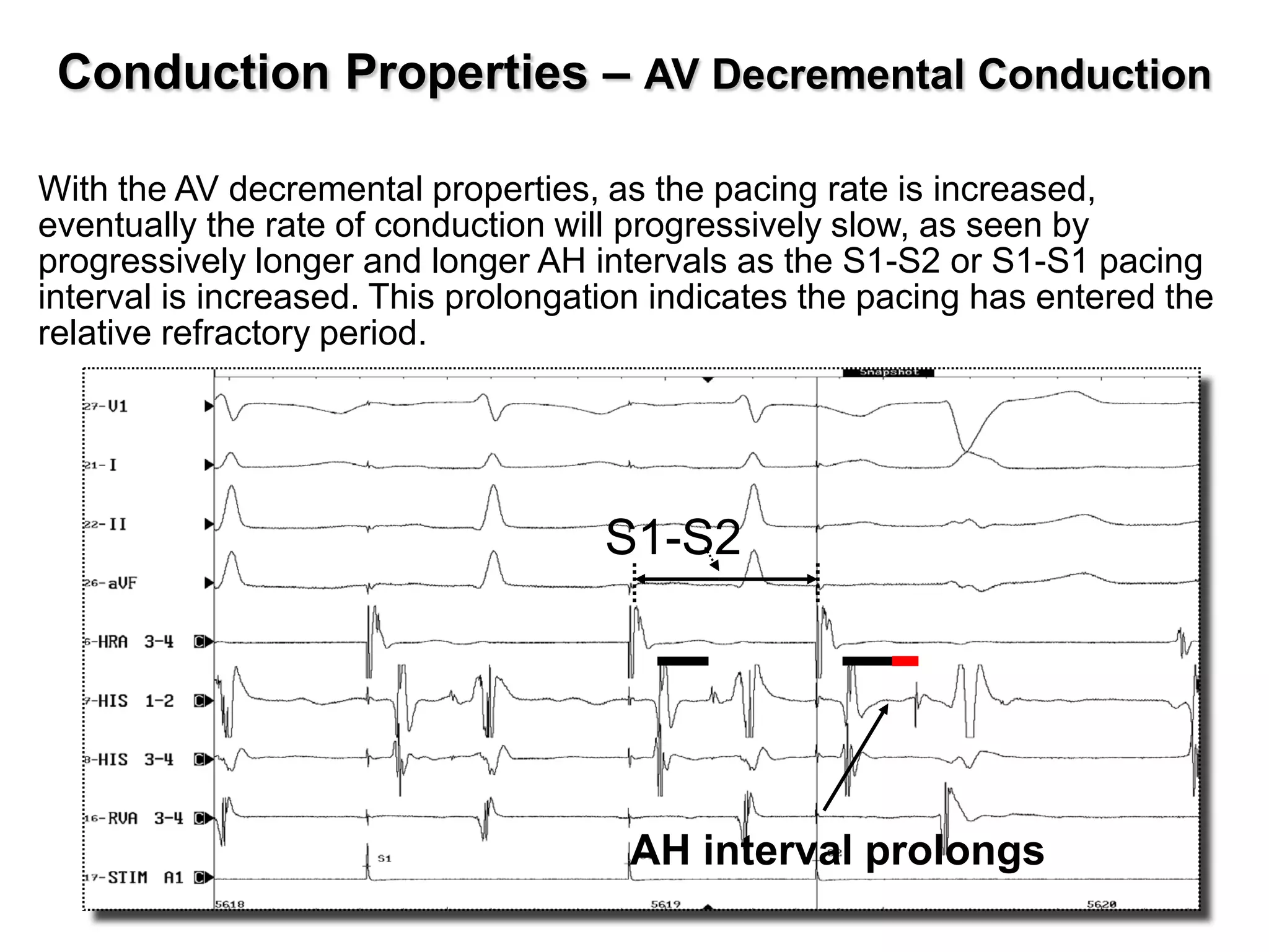Conduction Properties – AV Decremental Conduction

With the AV decremental properties, as the pacing rate is increased,
eventually the rate of conduction will progressively slow, as seen by
progressively longer and longer AH intervals as the S1-S2 or S1-S1 pacing
interval is increased. This prolongation indicates the pacing has entered the
relative refractory period.




                                     S1-S2




                                      AH interval prolongs
 23
 