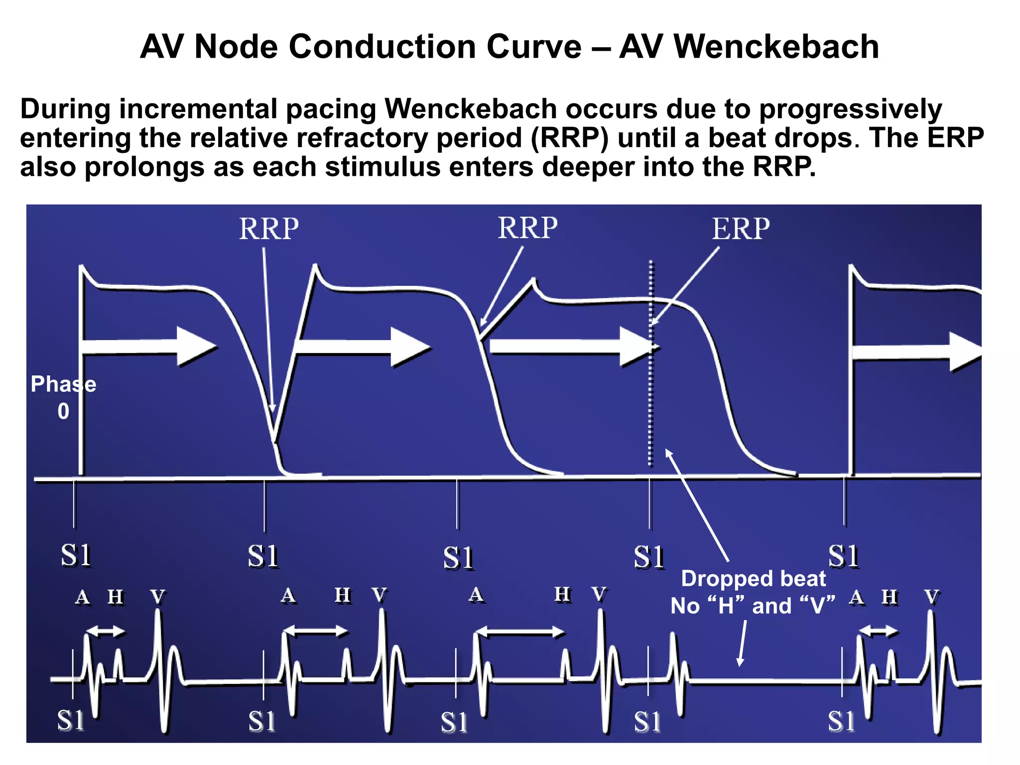 AV Node Conduction Curve – AV Wenckebach
During incremental pacing Wenckebach occurs due to progressively
entering the relative refractory period (RRP) until a beat drops. The ERP
also prolongs as each stimulus enters deeper into the RRP.




Phase
  0




                                                    Dropped beat
                                                   No “H” and “V”




  S1
 24              S1            S1             S1                S1
 