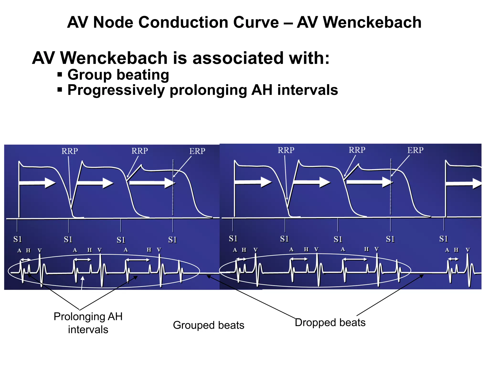 AV Node Conduction Curve – AV Wenckebach

     AV Wenckebach is associated with:
        Group beating
        Progressively prolonging AH intervals




       Prolonging AH
                       Grouped beats   Dropped beats
          intervals
25
 