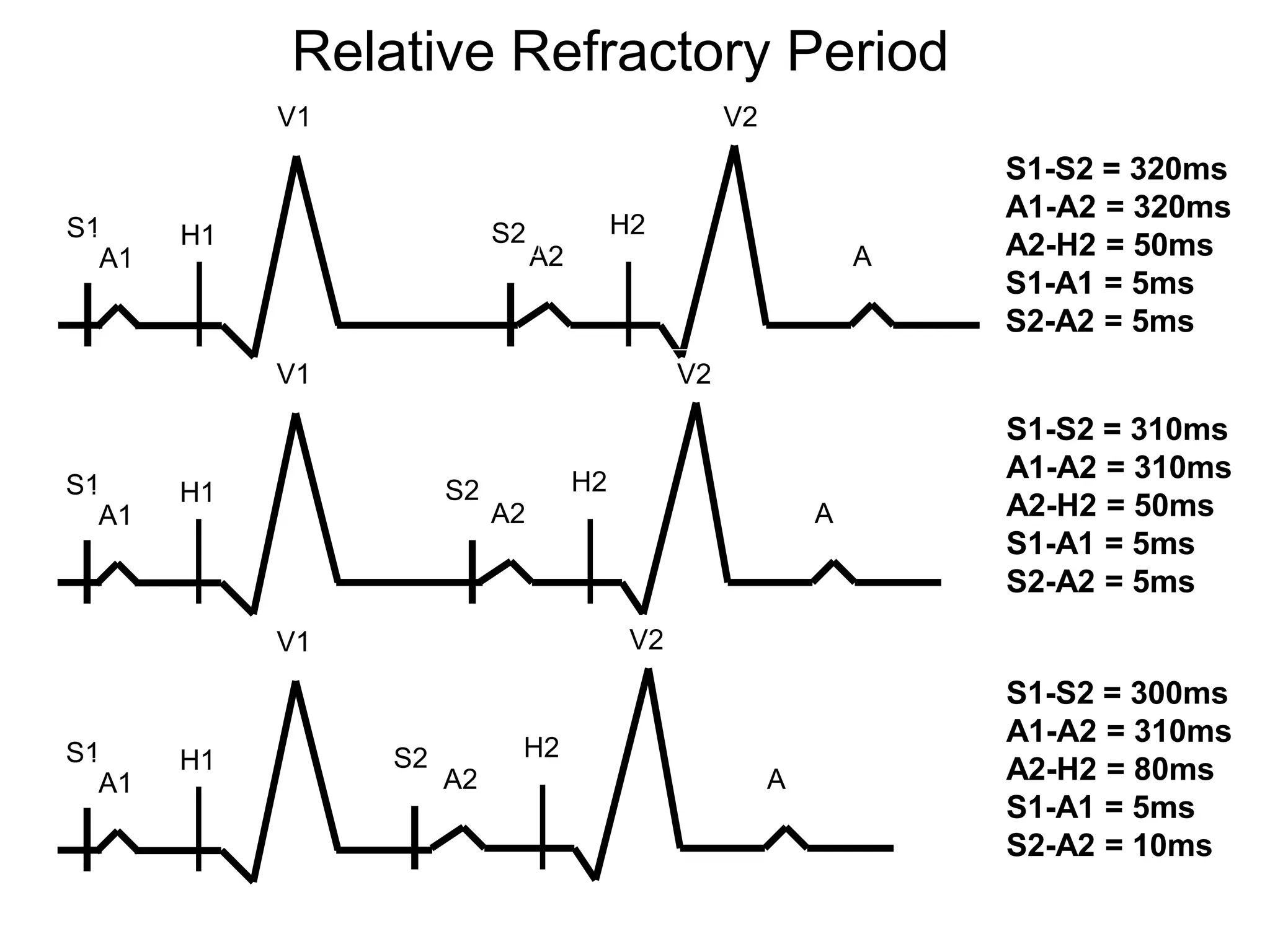 Relative Refractory Period
            V1                                       V2
                                                                      S1-S2 = 320ms
                                                                      A1-A2 = 320ms
S1     H1                  S2             H2
  A1                            A2                                A   A2-H2 = 50ms
                                                                      S1-A1 = 5ms
                                                                      S2-A2 = 5ms
            V1                                  V2

                                                                      S1-S2 = 310ms
                                     H2                               A1-A2 = 310ms
S1     H1             S2
  A1                       A2                                 A       A2-H2 = 50ms
                                                                      S1-A1 = 5ms
                                                                      S2-A2 = 5ms
            V1                             V2
                                                                      S1-S2 = 300ms
                            H2
                                                                      A1-A2 = 310ms
S1     H1        S2
  A1                  A2                                  A           A2-H2 = 80ms
                                                                      S1-A1 = 5ms
                                                                      S2-A2 = 10ms
31
 