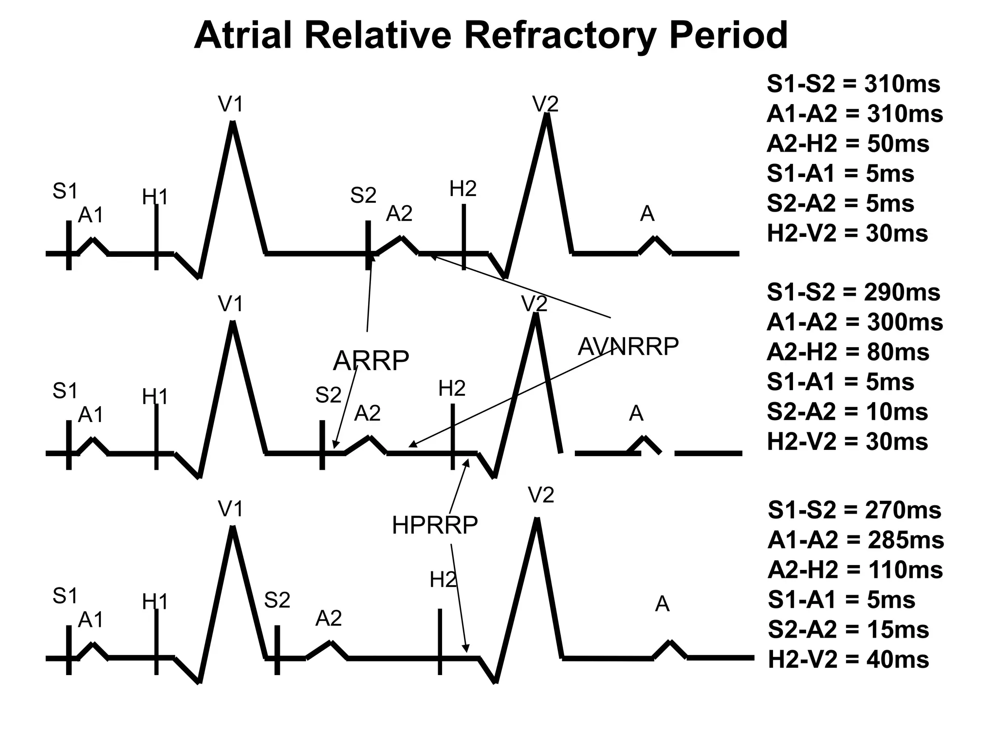 Atrial Relative Refractory Period
                                                            S1-S2 = 310ms
             V1                             V2              A1-A2 = 310ms
                                                            A2-H2 = 50ms
                                                            S1-A1 = 5ms
S1     H1                   S2         H2
  A1                             A2                 A       S2-A2 = 5ms
                                                            H2-V2 = 30ms

             V1                             V2              S1-S2 = 290ms
                                                            A1-A2 = 300ms
                                                 AVNRRP     A2-H2 = 80ms
                        ARRP
S1                     S2             H2                    S1-A1 = 5ms
       H1
  A1                        A2                      A       S2-A2 = 10ms
                                                            H2-V2 = 30ms

                                            V2
             V1                                             S1-S2 = 270ms
                                 HPRRP
                                                            A1-A2 = 285ms
                                      H2                    A2-H2 = 110ms
S1     H1         S2                                    A   S1-A1 = 5ms
  A1                   A2
                                                            S2-A2 = 15ms
                                                            H2-V2 = 40ms

36
 