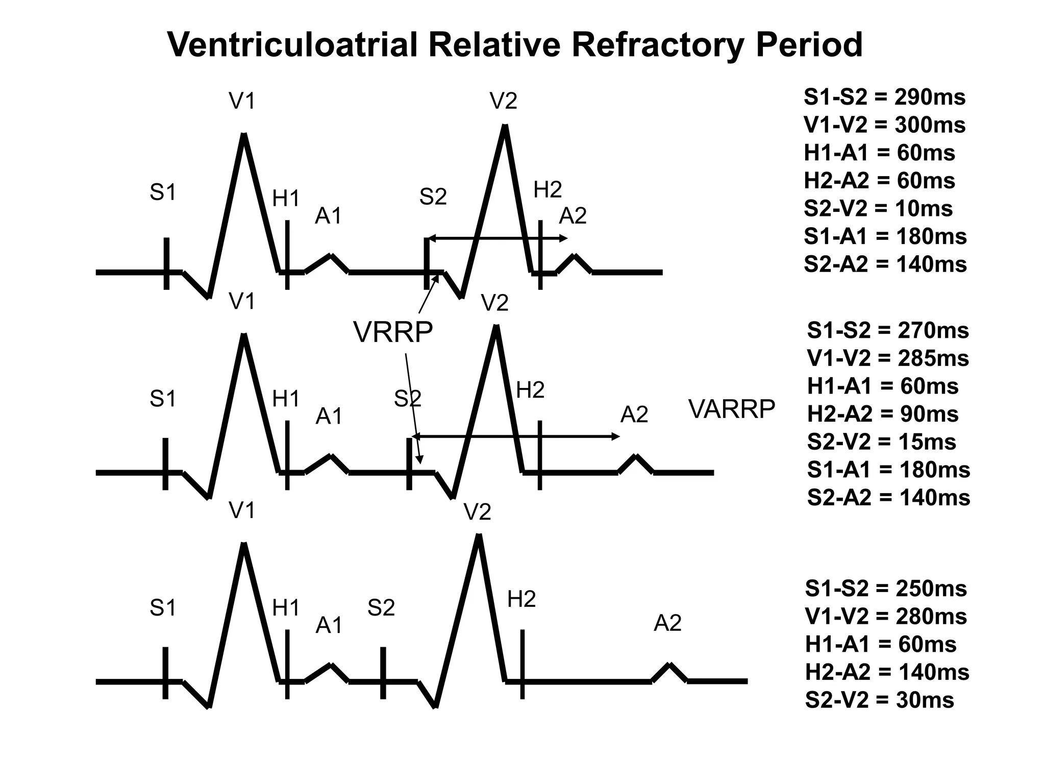 Ventriculoatrial Relative Refractory Period
          V1                        V2                             S1-S2 = 290ms
                                                                   V1-V2 = 300ms
                                                                   H1-A1 = 60ms
                                          H2                       H2-A2 = 60ms
     S1        H1             S2
                    A1                      A2                     S2-V2 = 10ms
                                                                   S1-A1 = 180ms
                                                                   S2-A2 = 140ms
          V1                        V2
                         VRRP                                      S1-S2 = 270ms
                                                                   V1-V2 = 285ms
                                         H2                        H1-A1 = 60ms
     S1        H1          S2                              VARRP
                    A1                           A2                H2-A2 = 90ms
                                                                   S2-V2 = 15ms
                                                                   S1-A1 = 180ms
                                                                   S2-A2 = 140ms
          V1                       V2


                                        H2                         S1-S2 = 250ms
     S1        H1        S2                                        V1-V2 = 280ms
                    A1                                A2
                                                                   H1-A1 = 60ms
                                                                   H2-A2 = 140ms
                                                                   S2-V2 = 30ms
40
 