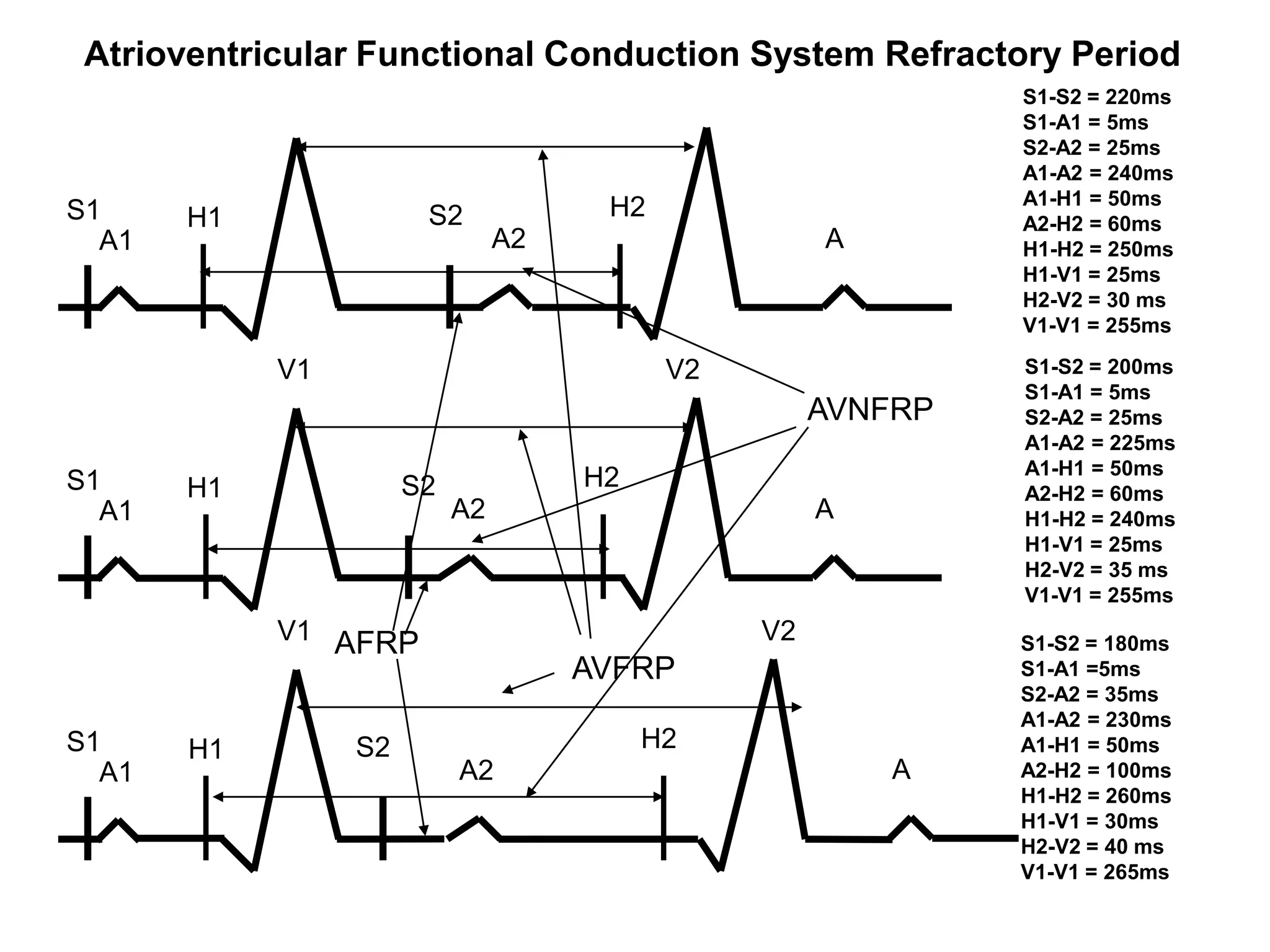 Atrioventricular Functional Conduction System Refractory Period
                                                                  S1-S2 = 220ms
                                                                  S1-A1 = 5ms
                                                                  S2-A2 = 25ms
                                                                  A1-A2 = 240ms
                                                                  A1-H1 = 50ms
S1        H1               S2             H2
                                                                  A2-H2 = 60ms
  A1                                A2                   A        H1-H2 = 250ms
                                                                  H1-V1 = 25ms
                                                                  H2-V2 = 30 ms
                                                                  V1-V1 = 255ms

                V1                             V2                 S1-S2 = 200ms
                                                                  S1-A1 = 5ms
                                                         AVNFRP   S2-A2 = 25ms
                                                                  A1-A2 = 225ms
                                                                  A1-H1 = 50ms
S1        H1              S2             H2
                                                                  A2-H2 = 60ms
  A1                           A2                        A        H1-H2 = 240ms
                                                                  H1-V1 = 25ms
                                                                  H2-V2 = 35 ms
                                                                  V1-V1 = 255ms
                V1 AFRP                             V2            S1-S2 = 180ms
                                         AVFRP                    S1-A1 =5ms
                                                                  S2-A2 = 35ms
                                                                  A1-A2 = 230ms
S1        H1         S2                       H2                  A1-H1 = 50ms
  A1                           A2                            A    A2-H2 = 100ms
                                                                  H1-H2 = 260ms
                                                                  H1-V1 = 30ms
                                                                  H2-V2 = 40 ms
                                                                  V1-V1 = 265ms
45
 