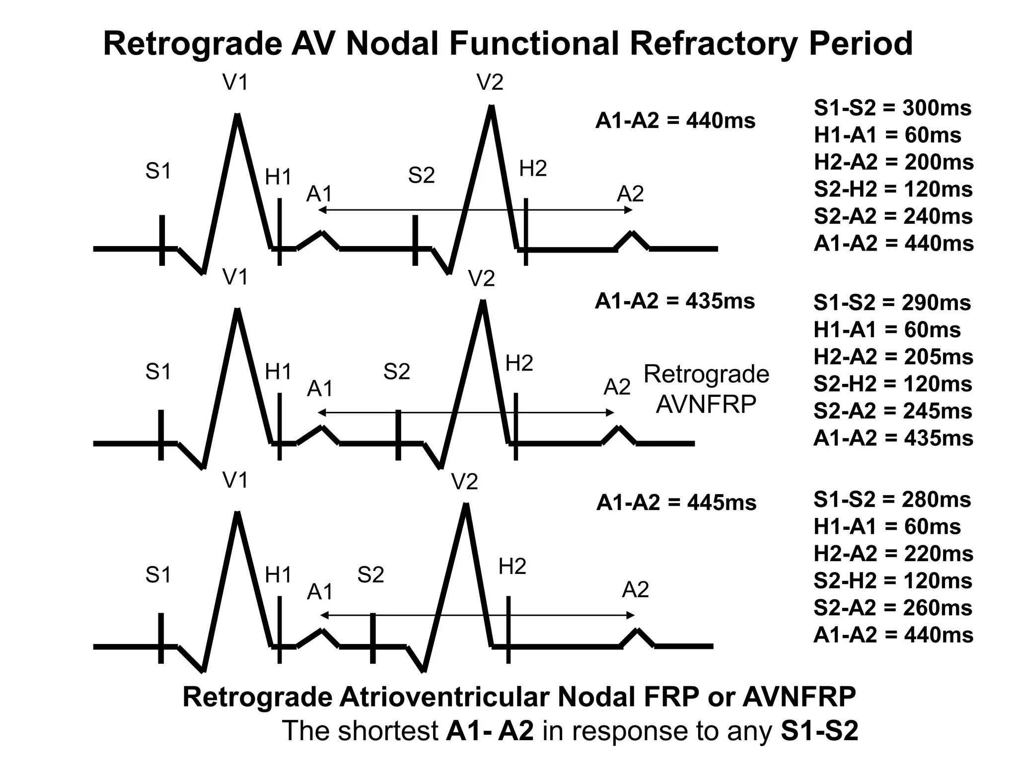 Retrograde AV Nodal Functional Refractory Period
               V1                        V2
                                                                      S1-S2 = 300ms
                                                    A1-A2 = 440ms
                                                                      H1-A1 = 60ms
       S1                                      H2                     H2-A2 = 200ms
                    H1             S2
                         A1                          A2               S2-H2 = 120ms
                                                                      S2-A2 = 240ms
                                                                      A1-A2 = 440ms
               V1                        V2
                                                    A1-A2 = 435ms     S1-S2 = 290ms
                                                                      H1-A1 = 60ms
                                              H2                      H2-A2 = 205ms
       S1           H1         S2                        Retrograde
                         A1                         A2                S2-H2 = 120ms
                                                          AVNFRP      S2-A2 = 245ms
                                                                      A1-A2 = 435ms
               V1                       V2
                                                    A1-A2 = 445ms     S1-S2 = 280ms
                                                                      H1-A1 = 60ms
                                                                      H2-A2 = 220ms
       S1           H1        S2              H2
                         A1                           A2              S2-H2 = 120ms
                                                                      S2-A2 = 260ms
                                                                      A1-A2 = 440ms

            Retrograde Atrioventricular Nodal FRP or AVNFRP
47                 The shortest A1- A2 in response to any S1-S2
 
