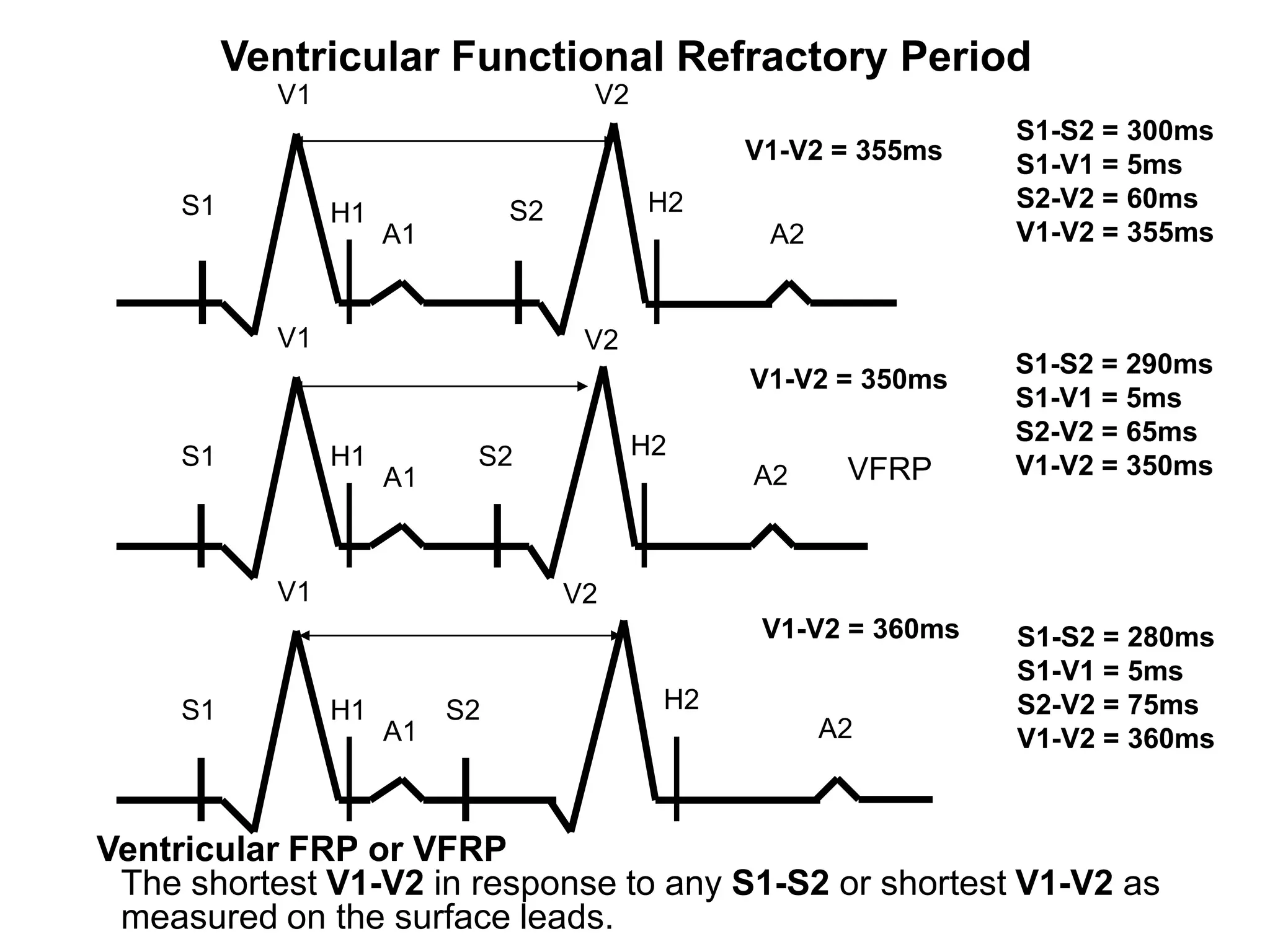 Ventricular Functional Refractory Period
                 V1                        V2
                                                                       S1-S2 = 300ms
                                                      V1-V2 = 355ms    S1-V1 = 5ms
          S1                         S2         H2                     S2-V2 = 60ms
                      H1
                           A1                          A2              V1-V2 = 355ms


                 V1                        V2
                                                                       S1-S2 = 290ms
                                                      V1-V2 = 350ms
                                                                       S1-V1 = 5ms
                                                                       S2-V2 = 65ms
          S1          H1         S2             H2
                           A1                         A2     VFRP      V1-V2 = 350ms



                 V1                       V2
                                                       V1-V2 = 360ms   S1-S2 = 280ms
                                                                       S1-V1 = 5ms
          S1          H1        S2               H2                    S2-V2 = 75ms
                           A1                               A2         V1-V2 = 360ms



     Ventricular FRP or VFRP
      The shortest V1-V2 in response to any S1-S2 or shortest V1-V2 as
48
      measured on the surface leads.
 
