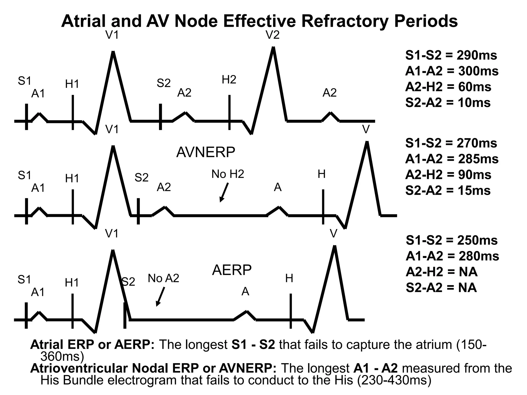 Atrial and AV Node Effective Refractory Periods
             V1                             V2
                                                                 S1-S2 = 290ms
                                                                 A1-A2 = 300ms
S1     H1               S2         H2
  A1                         A2                      A2          A2-H2 = 60ms
                                                                 S2-A2 = 10ms
             V1                                              V
                                                                 S1-S2 = 270ms
                             AVNERP                              A1-A2 = 285ms
S1     H1          S2             No H2              H           A2-H2 = 90ms
  A1                    A2                   A                   S2-A2 = 15ms


             V1                                          V
                                                                 S1-S2 = 250ms
                                                                 A1-A2 = 280ms
                       No A2
                                  AERP           H
                                                                 A2-H2 = NA
S1     H1         S2
  A1                                    A                        S2-A2 = NA



 Atrial ERP or AERP: The longest S1 - S2 that fails to capture the atrium (150-
   360ms)
 Atrioventricular Nodal ERP or AVNERP: The longest A1 - A2 measured from the
57 His Bundle electrogram that fails to conduct to the His (230-430ms)
 