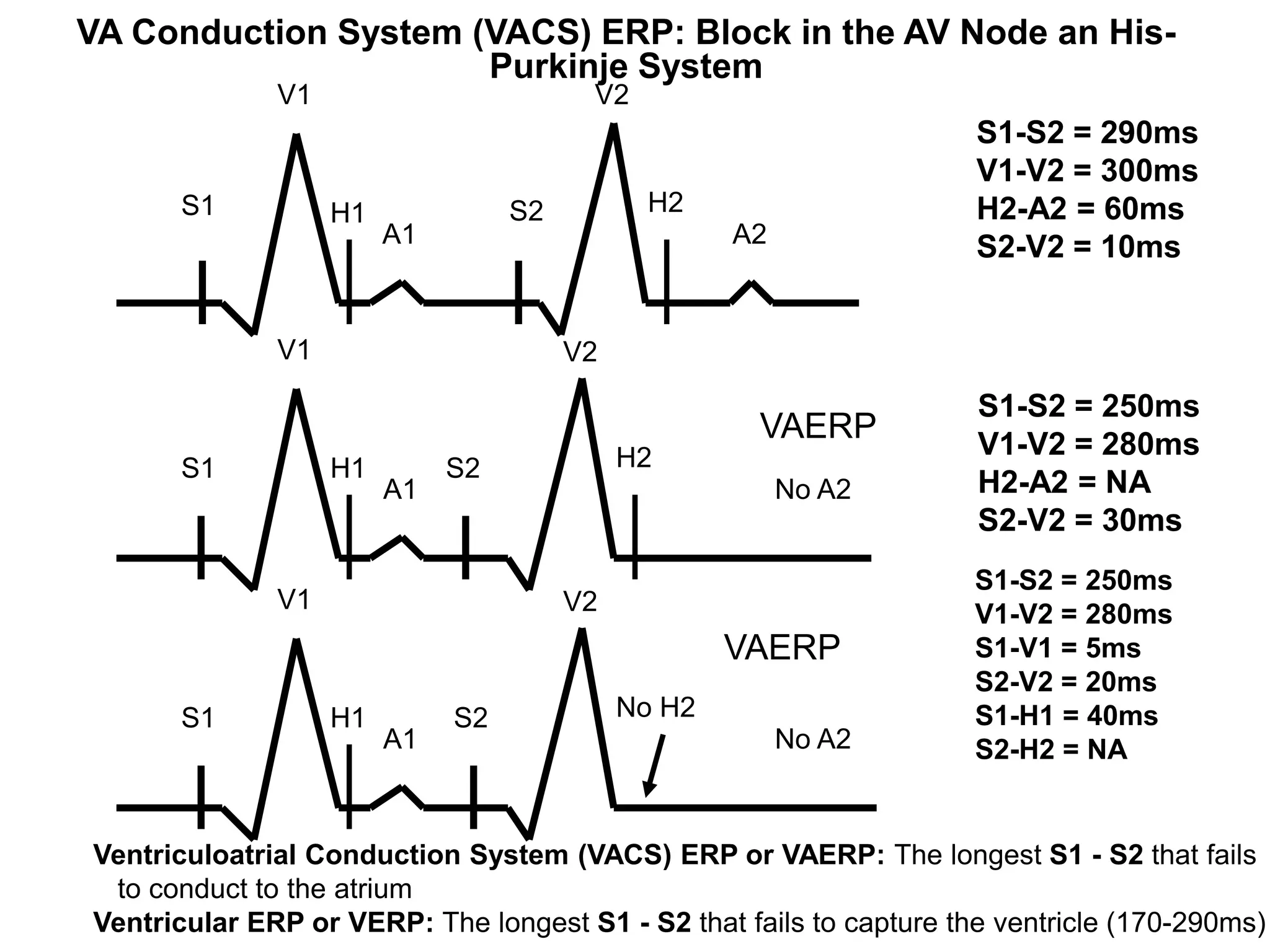 VA Conduction System (VACS) ERP: Block in the AV Node an His-
                       Purkinje System
                 V1                        V2
                                                                        S1-S2 = 290ms
                                                                        V1-V2 = 300ms
         S1           H1             S2         H2                      H2-A2 = 60ms
                           A1                          A2               S2-V2 = 10ms


                 V1                       V2
                                                                        S1-S2 = 250ms
                                                        VAERP           V1-V2 = 280ms
         S1           H1        S2             H2
                           A1                               No A2       H2-A2 = NA
                                                                        S2-V2 = 30ms
                                                                        S1-S2 = 250ms
                 V1                       V2                            V1-V2 = 280ms
                                                       VAERP            S1-V1 = 5ms
                                                                        S2-V2 = 20ms
         S1           H1        S2             No H2                    S1-H1 = 40ms
                           A1                               No A2       S2-H2 = NA


   Ventriculoatrial Conduction System (VACS) ERP or VAERP: The longest S1 - S2 that fails
    to conduct to the atrium
61
   Ventricular ERP or VERP: The longest S1 - S2 that fails to capture the ventricle (170-290ms)
 