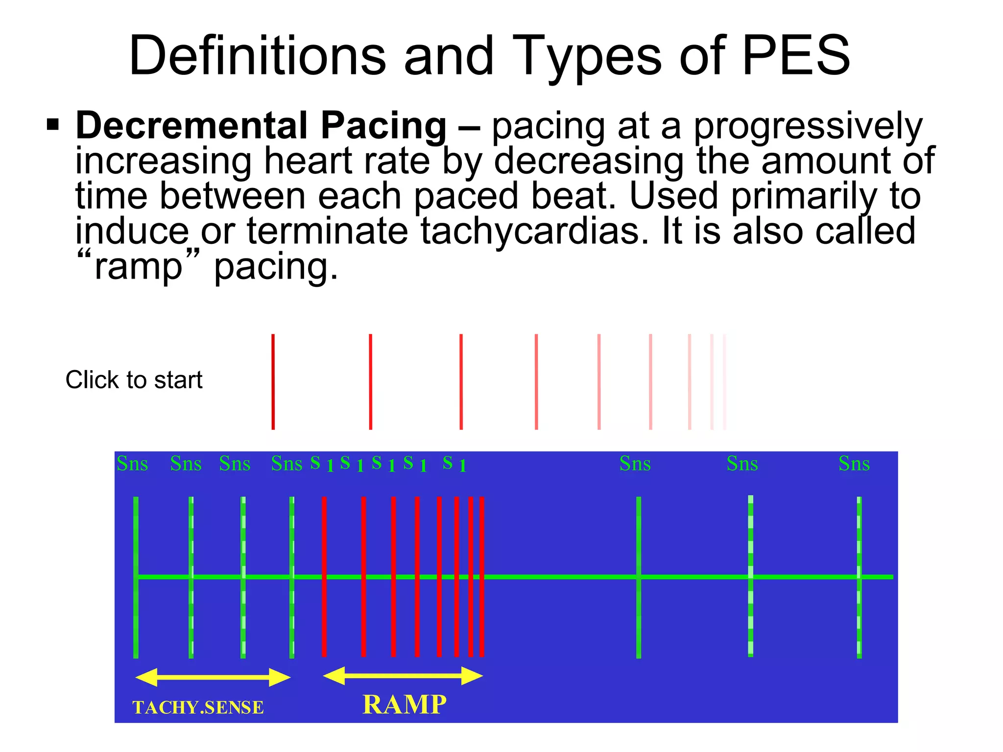 Definitions and Types of PES
 Decremental Pacing – pacing at a progressively
  increasing heart rate by decreasing the amount of
  time between each paced beat. Used primarily to
  induce or terminate tachycardias. It is also called
  “ramp” pacing.

    Click to start


         Sns Sns Sns Sns S 1 S 1 S 1 S 1 S 1   Sns   Sns   Sns




7         TACHY.SENSE            RAMP
 