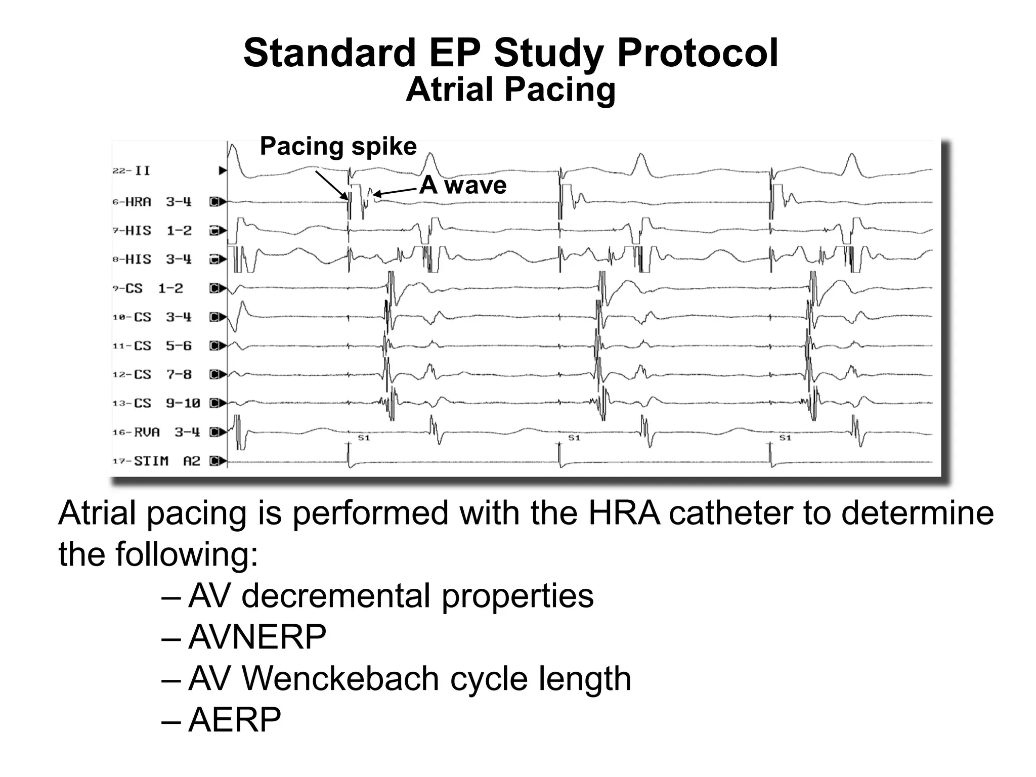 Standard EP Study Protocol
                         Atrial Pacing
              Pacing spike
                             A wave




 Atrial pacing is performed with the HRA catheter to determine
 the following:
         – AV decremental properties
         – AVNERP
         – AV Wenckebach cycle length
77
         – AERP
 