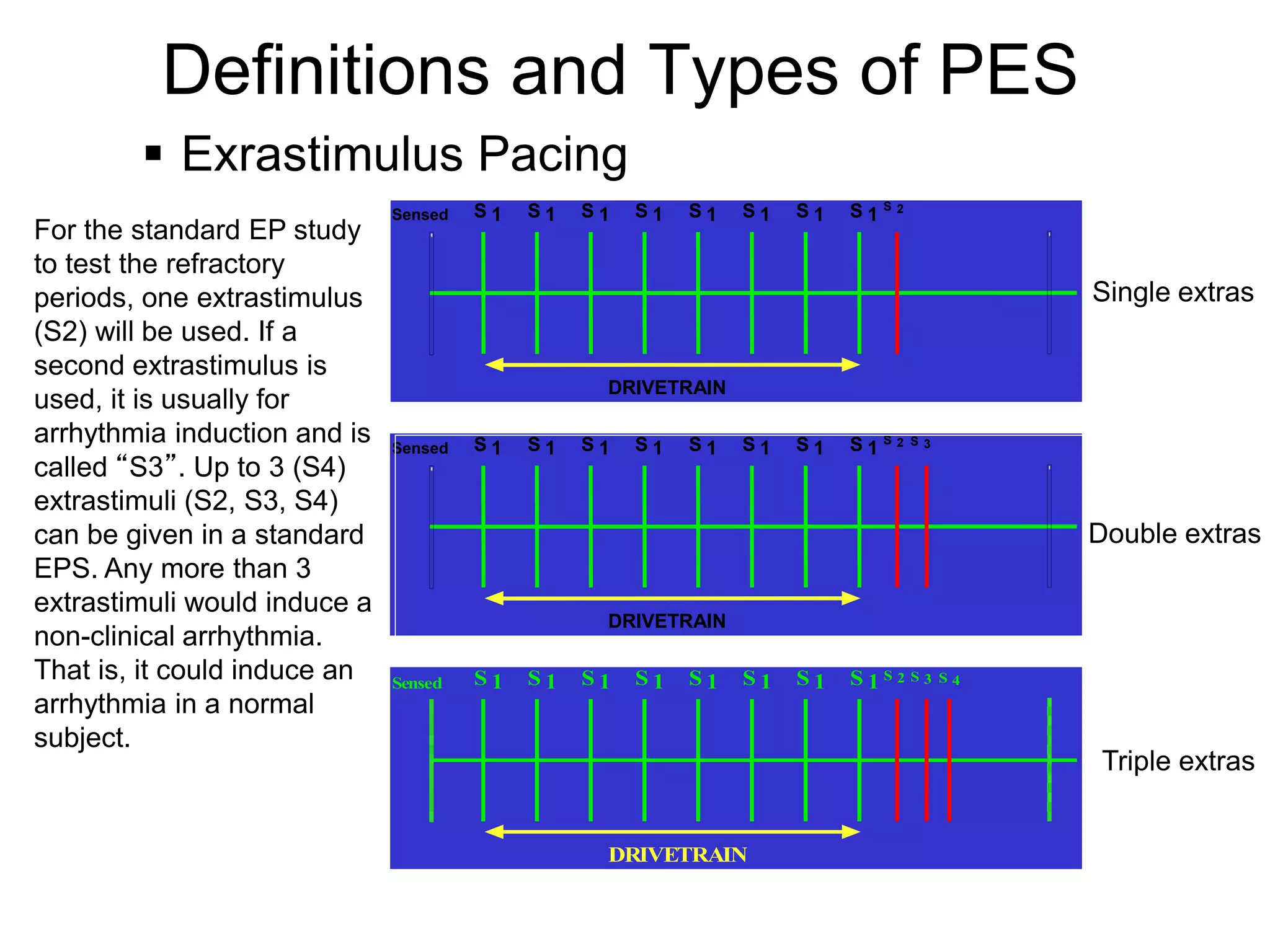 Definitions and Types of PES
         Exrastimulus Pacing
                              Sensed   S1   S1   S1   S1   S1   S1   S1   S1S2
For the standard EP study
to test the refractory
periods, one extrastimulus                                                                  Single extras
(S2) will be used. If a
second extrastimulus is
                                                  DRIVETRAIN
used, it is usually for
arrhythmia induction and is   Sensed   S1   S1   S1   S1   S1   S1   S1   S1S2   S 3

called “S3”. Up to 3 (S4)
extrastimuli (S2, S3, S4)
can be given in a standard                                                                  Double extras
EPS. Any more than 3
extrastimuli would induce a
                                                  DRIVETRAIN
non-clinical arrhythmia.
That is, it could induce an   Sensed   S1   S1   S1   S1   S1   S1   S1   S1S2 S3      S4

arrhythmia in a normal
subject.
                                                                                             Triple extras


                                                  DRIVETRAIN

  8
 