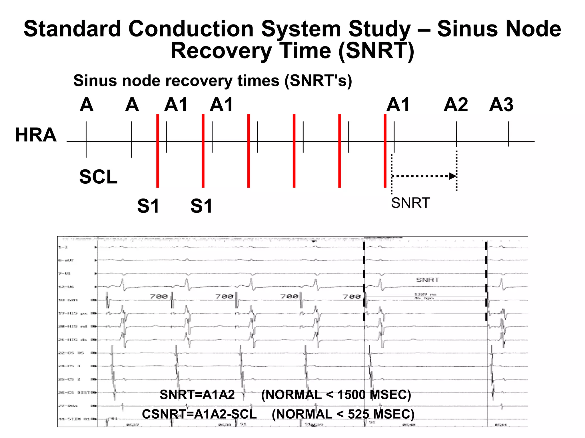 Standard Conduction System Study – Sinus Node
            Recovery Time (SNRT)
      Sinus node recovery times (SNRT's)
      A     A     A1    A1                       A1      A2   A3
HRA

      SCL
             S1        S1                         SNRT




                  SNRT=A1A2      (NORMAL < 1500 MSEC)
80              CSNRT=A1A2-SCL    (NORMAL < 525 MSEC)
 
