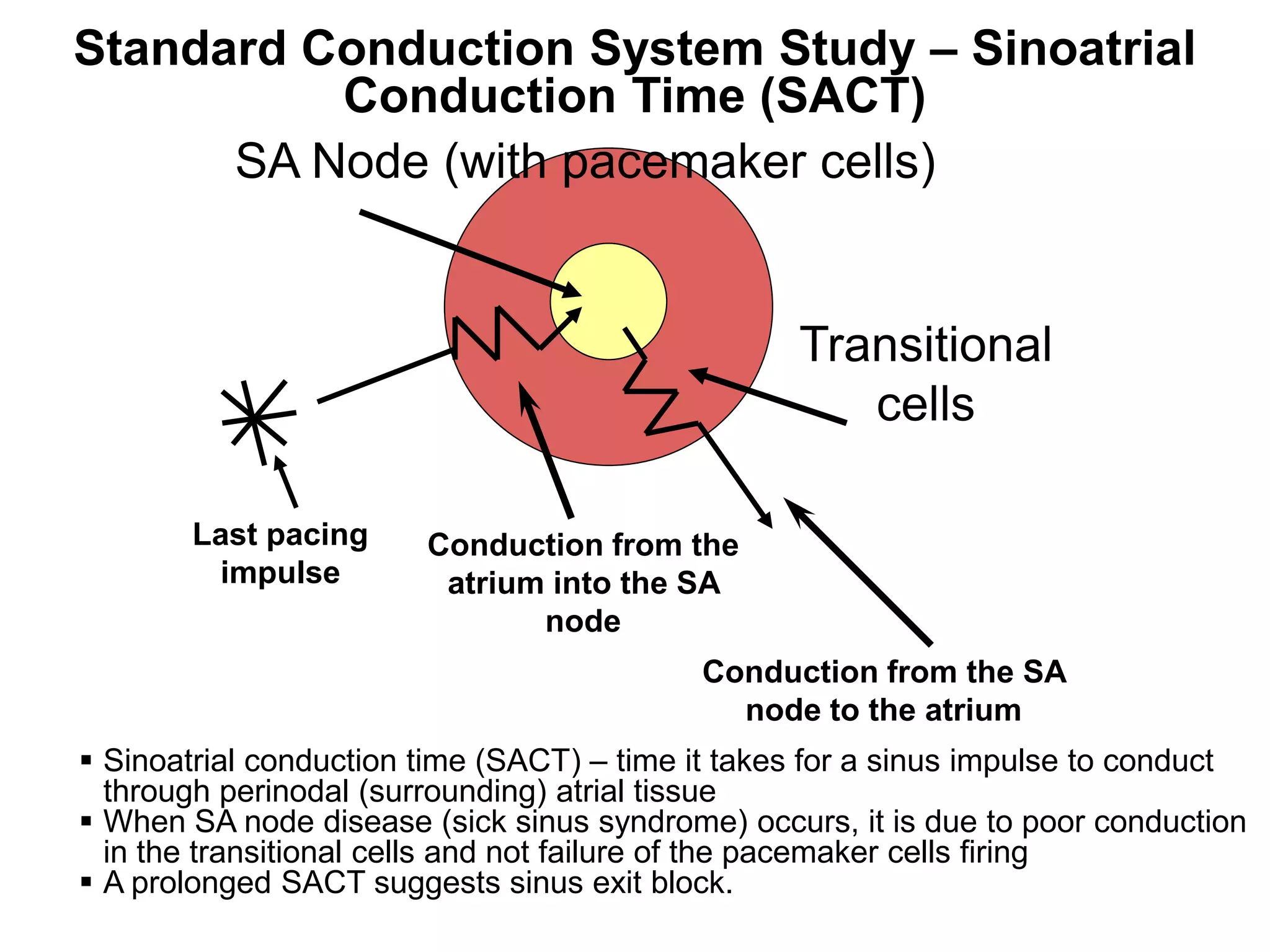Standard Conduction System Study – Sinoatrial
           Conduction Time (SACT)
       SA Node (with pacemaker cells)


                                                   Transitional
                                                      cells

        Last pacing      Conduction from the
         impulse          atrium into the SA
                                node
                                            Conduction from the SA
                                              node to the atrium
  Sinoatrial conduction time (SACT) – time it takes for a sinus impulse to conduct
   through perinodal (surrounding) atrial tissue
  When SA node disease (sick sinus syndrome) occurs, it is due to poor conduction
   in the transitional cells and not failure of the pacemaker cells firing
  A prolonged SACT suggests sinus exit block.
81
 