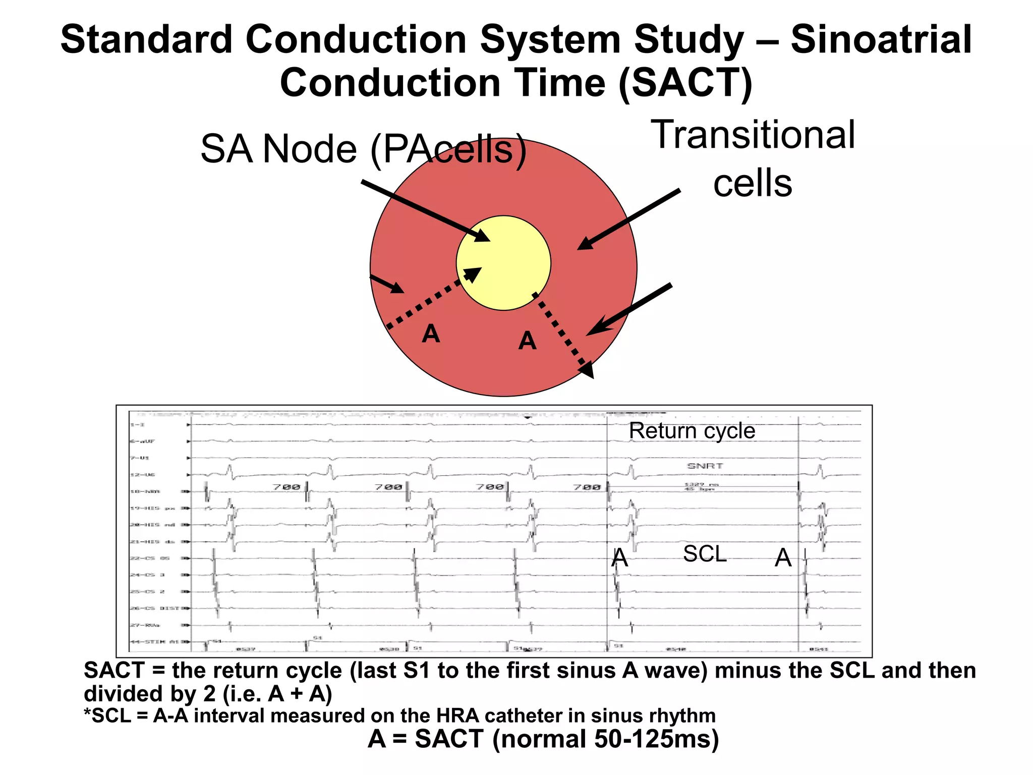 Standard Conduction System Study – Sinoatrial
           Conduction Time (SACT)
       SA Node (PAcells)     Transitional
                                cells


                                       A        A


                                                              Return cycle




                                                          A        SCL       A



     SACT = the return cycle (last S1 to the first sinus A wave) minus the SCL and then
     divided by 2 (i.e. A + A)
     *SCL = A-A interval measured on the HRA catheter in sinus rhythm
83                               A = SACT (normal 50-125ms)
 
