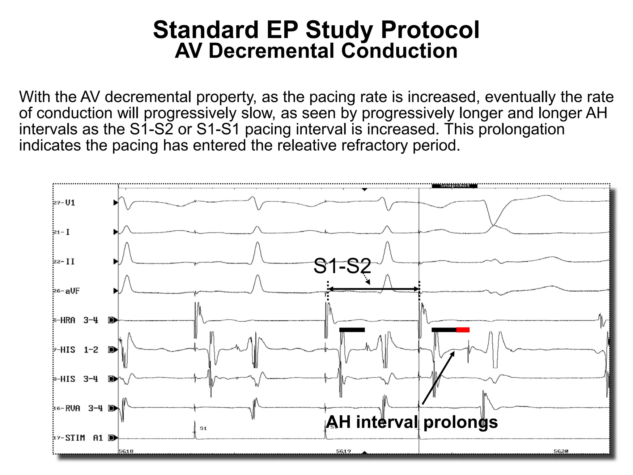 Standard EP Study Protocol
                      AV Decremental Conduction

With the AV decremental property, as the pacing rate is increased, eventually the rate
of conduction will progressively slow, as seen by progressively longer and longer AH
intervals as the S1-S2 or S1-S1 pacing interval is increased. This prolongation
indicates the pacing has entered the releative refractory period.




                                          S1-S2




                                            AH interval prolongs
 86
 