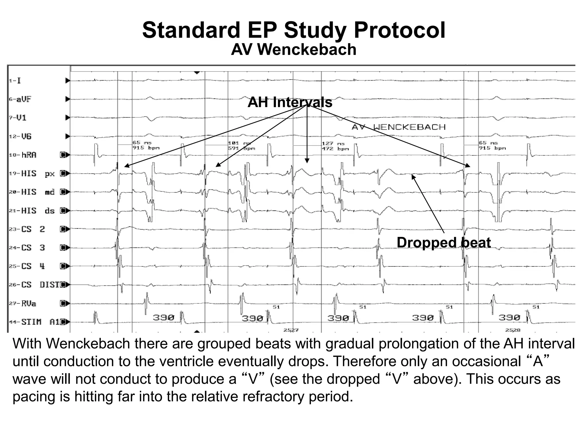 Standard EP Study Protocol
                                AV Wenckebach


                                   AH Intervals




                                                         Dropped beat




With Wenckebach there are grouped beats with gradual prolongation of the AH interval
until conduction to the ventricle eventually drops. Therefore only an occasional “A”
wave will not conduct to produce a “V” (see the dropped “V” above). This occurs as
pacing is hitting far into the relative refractory period.
 87
 