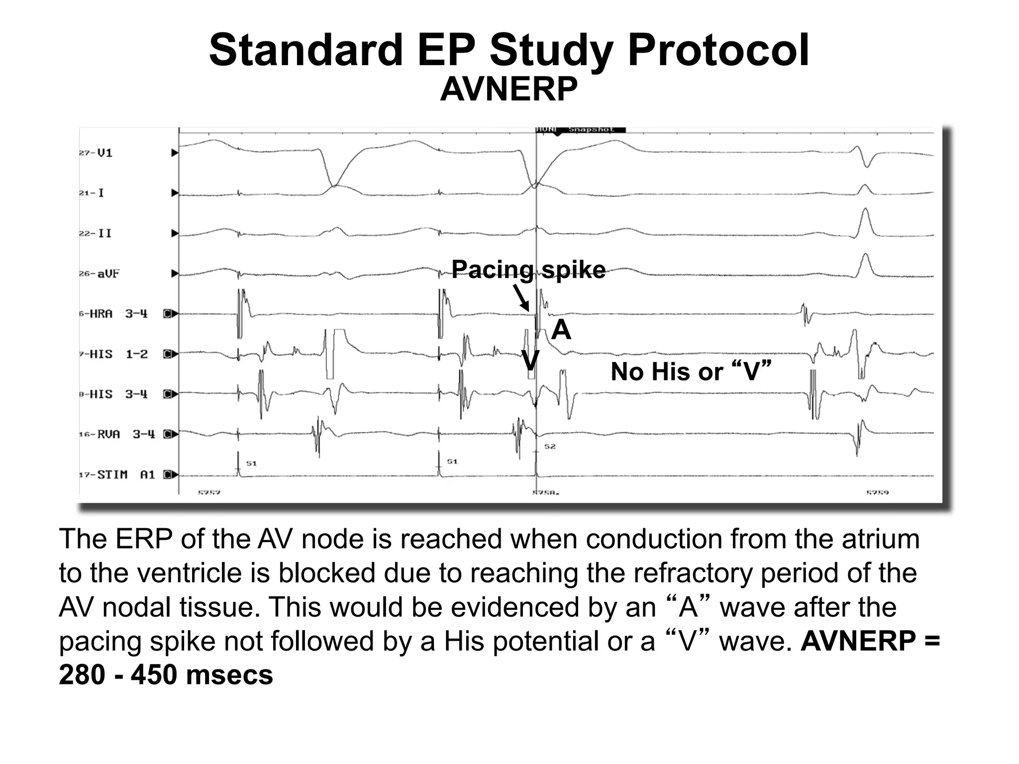 Standard EP Study Protocol
                                AVNERP




                                 Pacing spike

                                          A
                                      V         No His or “V”




 The ERP of the AV node is reached when conduction from the atrium
 to the ventricle is blocked due to reaching the refractory period of the
 AV nodal tissue. This would be evidenced by an “A” wave after the
 pacing spike not followed by a His potential or a “V” wave. AVNERP =
 280 - 450 msecs
88
 