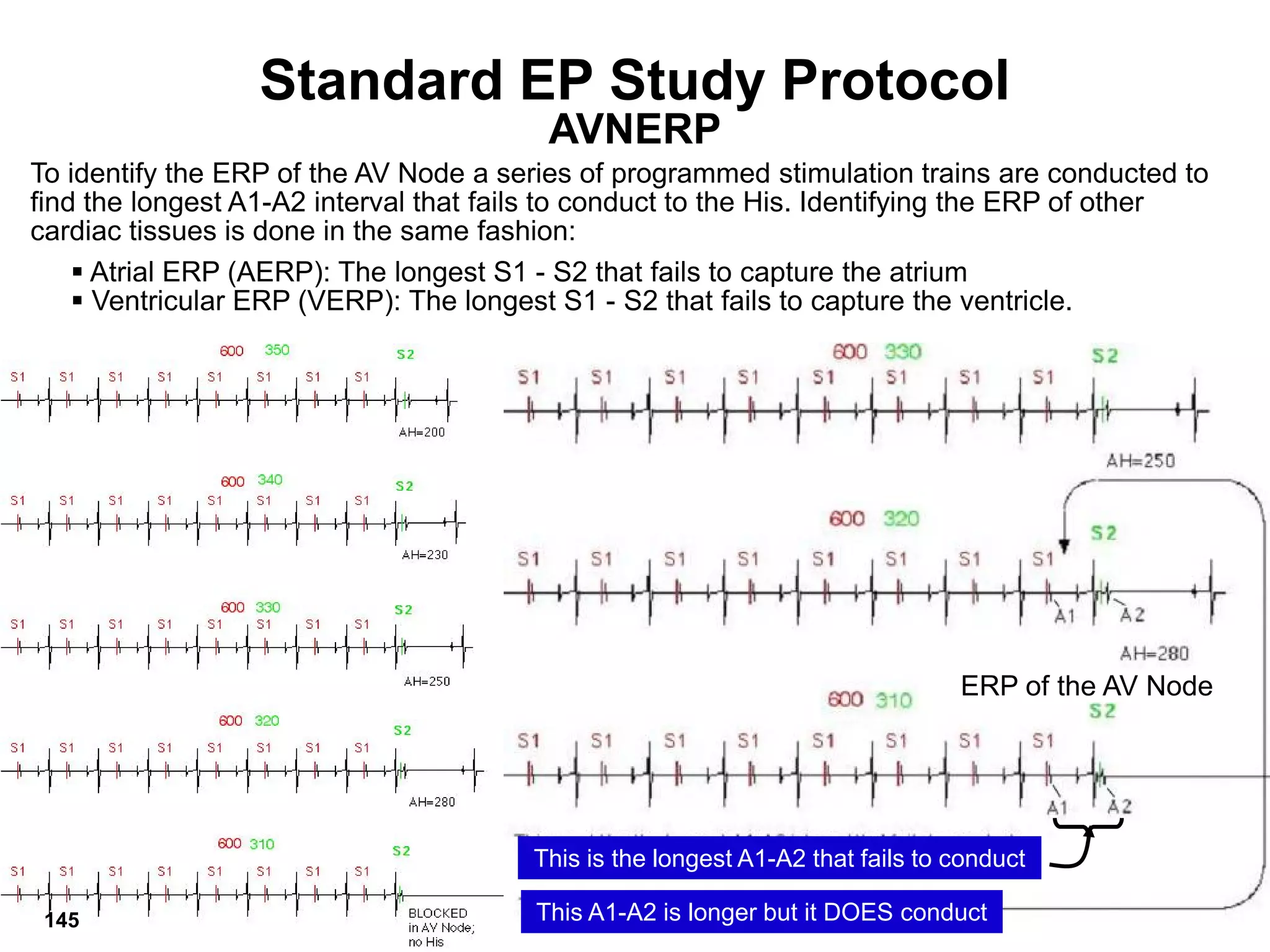 Standard EP Study Protocol
                                         AVNERP
To identify the ERP of the AV Node a series of programmed stimulation trains are conducted to
find the longest A1-A2 interval that fails to conduct to the His. Identifying the ERP of other
cardiac tissues is done in the same fashion:
     Atrial ERP (AERP): The longest S1 - S2 that fails to capture the atrium
     Ventricular ERP (VERP): The longest S1 - S2 that fails to capture the ventricle.




                                                                                ERP of the AV Node




                                        This is the longest A1-A2 that fails to conduct
 89                                     This A1-A2 is longer but it DOES conduct
 145
 