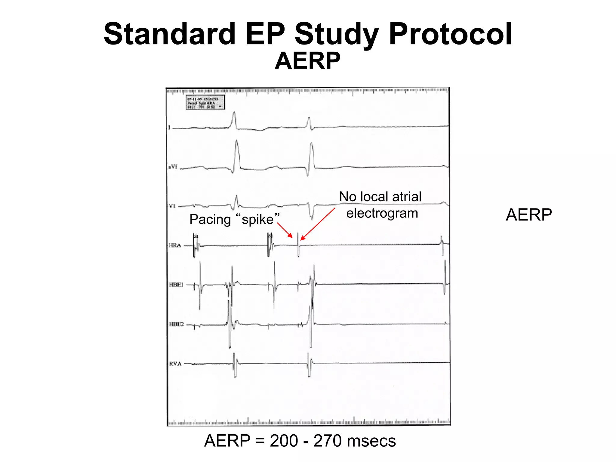 Standard EP Study Protocol
                       AERP




                           No local atrial
          Pacing “spike”    electrogram      AERP




90          AERP = 200 - 270 msecs
 