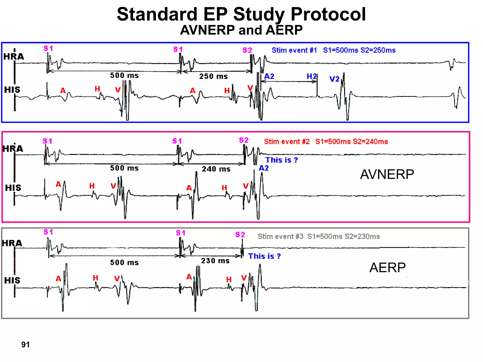 Standard EP Study Protocol
           AVNERP and AERP




                              AVNERP




                                  AERP




91
 