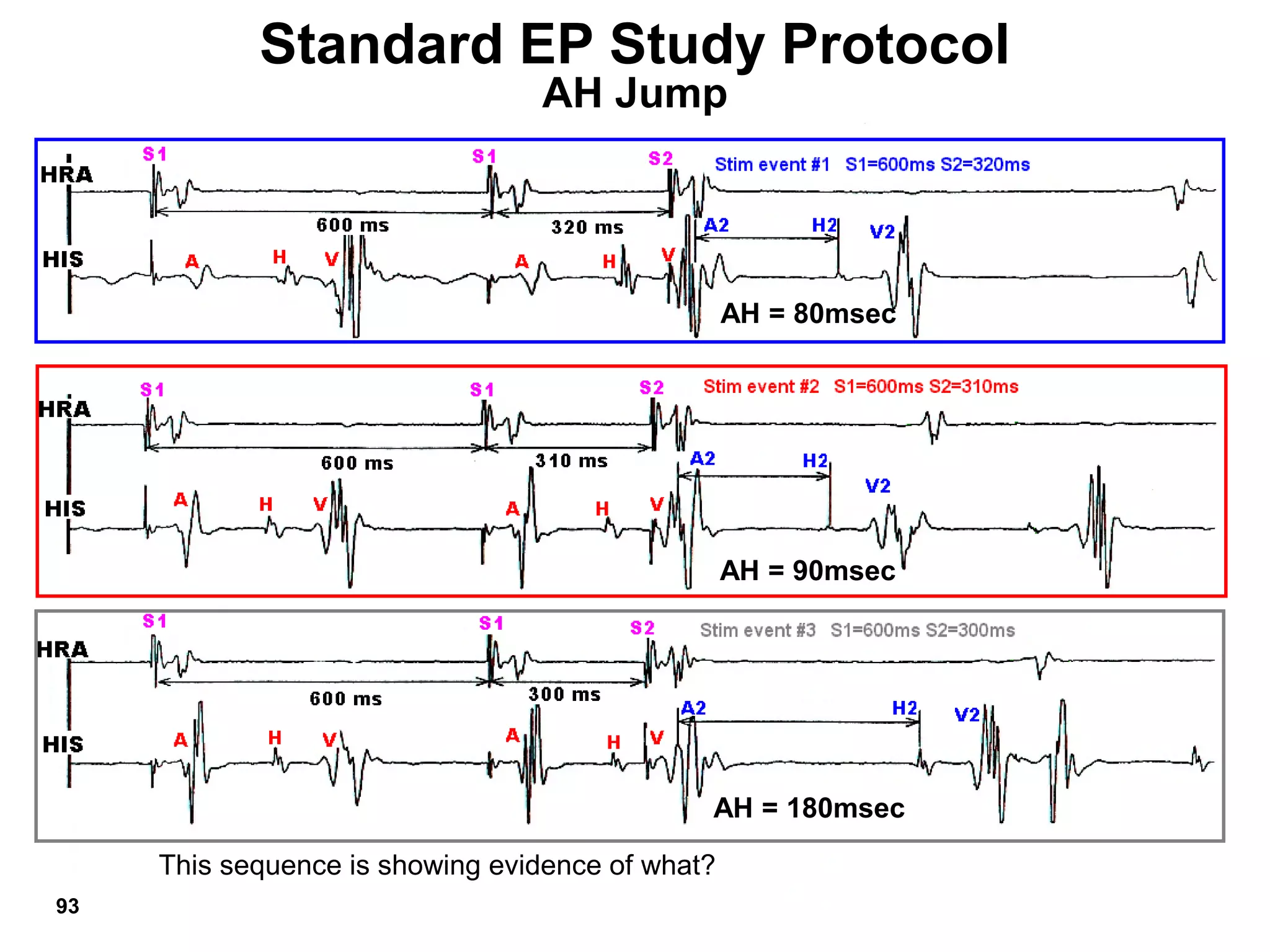 Standard EP Study Protocol
                                 AH Jump




                                                  AH = 80msec




                                                  AH = 90msec




                                              AH = 180msec

     This sequence is showing evidence of what?
93
 