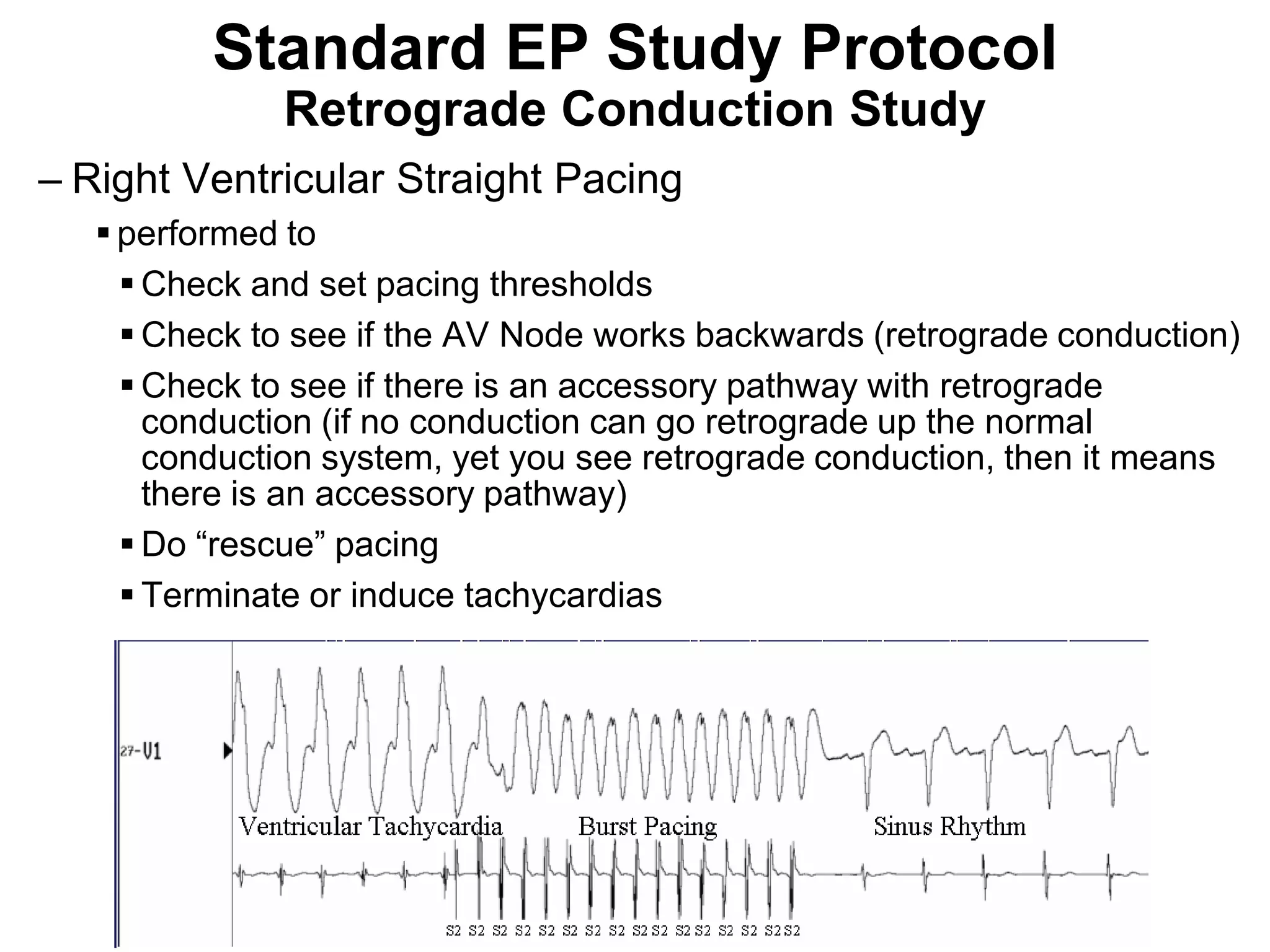 Standard EP Study Protocol
                Retrograde Conduction Study
– Right Ventricular Straight Pacing
      performed to
        Check and set pacing thresholds
        Check to see if the AV Node works backwards (retrograde conduction)
        Check to see if there is an accessory pathway with retrograde
         conduction (if no conduction can go retrograde up the normal
         conduction system, yet you see retrograde conduction, then it means
         there is an accessory pathway)
        Do “rescue” pacing
        Terminate or induce tachycardias




95
 