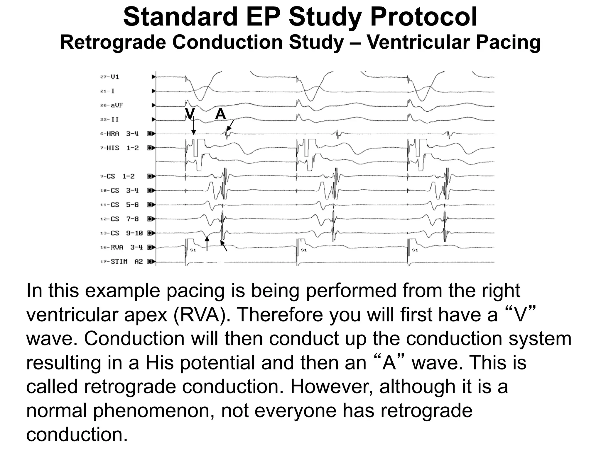 Standard EP Study Protocol
   Retrograde Conduction Study – Ventricular Pacing


                 V    A




                     VA
In this example pacing is being performed from the right
ventricular apex (RVA). Therefore you will first have a “V”
wave. Conduction will then conduct up the conduction system
resulting in a His potential and then an “A” wave. This is
called retrograde conduction. However, although it is a
normal phenomenon, not everyone has retrograde
96
conduction.
 