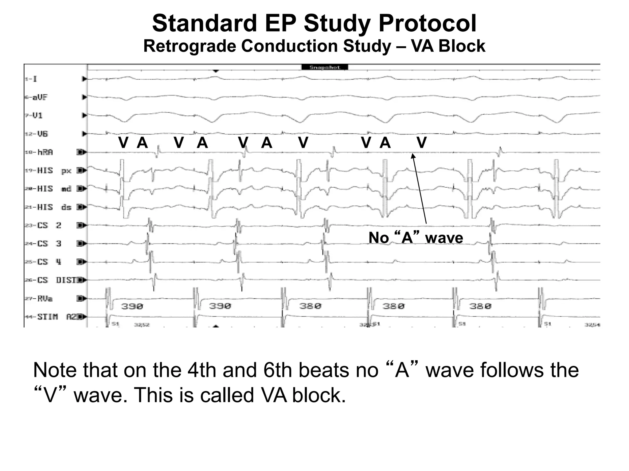 Standard EP Study Protocol
           Retrograde Conduction Study – VA Block




         V A    V A   V A   V      V A   V




                                   No “A” wave




Note that on the 4th and 6th beats no “A” wave follows the
“V” wave. This is called VA block.

97
 