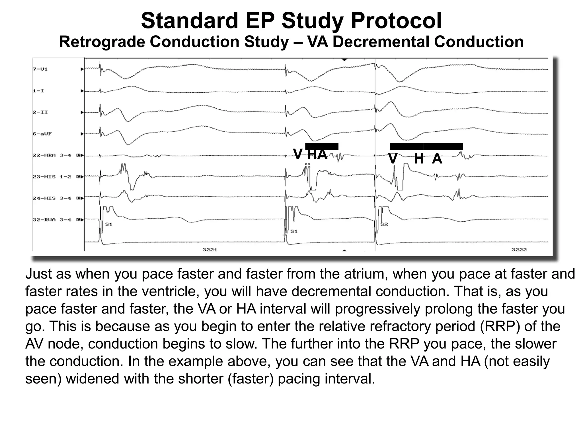 Standard EP Study Protocol
     Retrograde Conduction Study – VA Decremental Conduction




                                          V HA           V   H A




Just as when you pace faster and faster from the atrium, when you pace at faster and
faster rates in the ventricle, you will have decremental conduction. That is, as you
pace faster and faster, the VA or HA interval will progressively prolong the faster you
go. This is because as you begin to enter the relative refractory period (RRP) of the
AV node, conduction begins to slow. The further into the RRP you pace, the slower
the conduction. In the example above, you can see that the VA and HA (not easily
seen) widened with the shorter (faster) pacing interval.

98
 