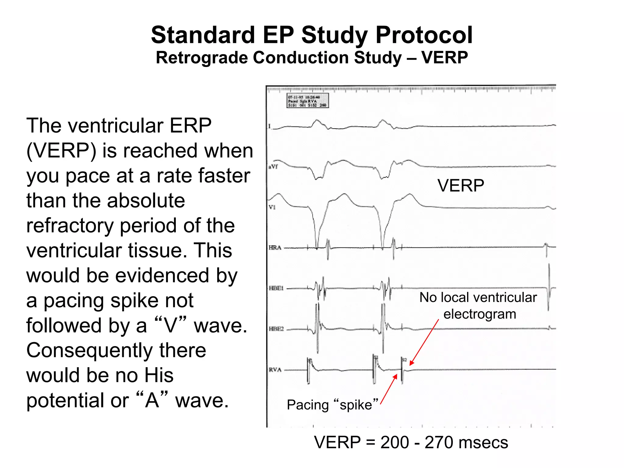 Standard EP Study Protocol
              Retrograde Conduction Study – VERP


The ventricular ERP
(VERP) is reached when
you pace at a rate faster                       VERP
than the absolute
refractory period of the
ventricular tissue. This
would be evidenced by
a pacing spike not                           No local ventricular
                                                 electrogram
followed by a “V” wave.
Consequently there
would be no His
potential or “A” wave.      Pacing “spike”

99                              VERP = 200 - 270 msecs
 