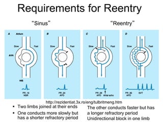 Requirements for Reentry
             “Sinus”                                     “Reentry”




                    http://rezidentiat.3x.ro/eng/tulbritmeng.htm
     Two limbs joined at their ends       The other conducts faster but has
     One conducts more slowly but         a longer refractory period
107
      has a shorter refractory period      Unidirectional block in one limb
 