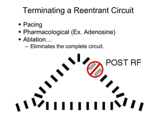 Terminating a Reentrant Circuit
       Pacing
       Pharmacological (Ex. Adenosine)
       Ablation…
        – Eliminates the complete circuit.




110
 