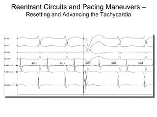 Reentrant Circuits and Pacing Maneuvers –
          Resetting and Advancing the Tachycardia




112
 