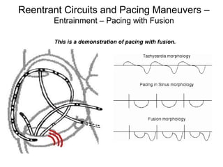 Reentrant Circuits and Pacing Maneuvers –
             Entrainment – Pacing with Fusion

             This is a demonstration of pacing with fusion.




115
 