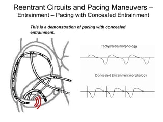 Reentrant Circuits and Pacing Maneuvers –
       Entrainment – Pacing with Concealed Entrainment
           This is a demonstration of pacing with concealed
           entrainment.




116
 