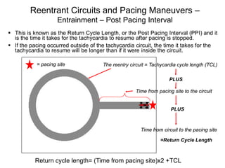 Reentrant Circuits and Pacing Maneuvers –
                    Entrainment – Post Pacing Interval
 This is known as the Return Cycle Length, or the Post Pacing Interval (PPI) and it
  is the time it takes for the tachycardia to resume after pacing is stopped.
 If the pacing occurred outside of the tachycardia circuit, the time it takes for the
  tachycardia to resume will be longer than if it were inside the circuit.

           = pacing site              The reentry circuit = Tachycardia cycle length (TCL)

                                                                    PLUS

                                                    Time from pacing site to the circuit


                                                                     PLUS



                                                       Time from circuit to the pacing site

                                                                =Return Cycle Length


117        Return cycle length= (Time from pacing site)x2 +TCL
 