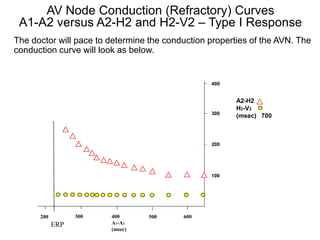 AV Node Conduction (Refractory) Curves
 A1-A2 versus A2-H2 and H2-V2 – Type I Response
The doctor will pace to determine the conduction properties of the AVN. The
conduction curve will look as below.


                                                 400


                                                        A2-H2
                                                        H2-V2
                                                 300
                                                        (msec) 700



                                                 200




                                                 100




      200         300   400       500     600
            ERP         A1-A2
19                      (msec)
 