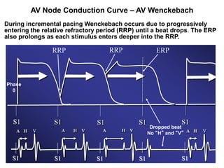 AV Node Conduction Curve – AV Wenckebach
During incremental pacing Wenckebach occurs due to progressively
entering the relative refractory period (RRP) until a beat drops. The ERP
also prolongs as each stimulus enters deeper into the RRP.




Phase
  0




                                                    Dropped beat
                                                   No “H” and “V”




  S1
 24              S1            S1             S1                S1
 