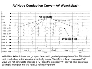 AV Node Conduction Curve – AV Wenckebach


                                   AH Intervals




                                                         Dropped beat




With Wenckebach there are grouped beats with gradual prolongation of the AH interval
until conduction to the ventricle eventually drops. Therefore only an occasional “A”
wave will not conduct to produce a “V” (see the dropped “V” above). This occurs as
pacing is hitting far into the relative refractory period.
  26
 