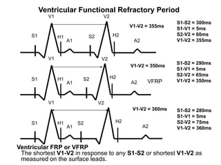 Ventricular Functional Refractory Period
                 V1                        V2
                                                                       S1-S2 = 300ms
                                                      V1-V2 = 355ms    S1-V1 = 5ms
          S1                         S2         H2                     S2-V2 = 60ms
                      H1
                           A1                          A2              V1-V2 = 355ms


                 V1                        V2
                                                                       S1-S2 = 290ms
                                                      V1-V2 = 350ms
                                                                       S1-V1 = 5ms
                                                                       S2-V2 = 65ms
          S1          H1         S2             H2
                           A1                         A2     VFRP      V1-V2 = 350ms



                 V1                       V2
                                                       V1-V2 = 360ms   S1-S2 = 280ms
                                                                       S1-V1 = 5ms
          S1          H1        S2               H2                    S2-V2 = 75ms
                           A1                               A2         V1-V2 = 360ms



     Ventricular FRP or VFRP
      The shortest V1-V2 in response to any S1-S2 or shortest V1-V2 as
48
      measured on the surface leads.
 