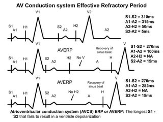 AV Conduction system Effective Refractory Period
              V1                                 V2
                                                                            S1-S2 = 310ms
                                                                            A1-A2 = 315ms
S1      H1                   S2          H2                                 A2-H2 = 50ms
  A1                              A2                           A2           S2-A2 = 5ms

              V1                                                            V
                                                      Recovery of               S1-S2 = 270ms
                             AVERP                     sinus beat               A1-A2 = 100ms
S1                                 H2     No V                      H           A2-H2 = NA
        H1         S2
  A1                    A2                            A                         S2-A2 = 15ms



              V1                                                        V
                             AVERP               Recovery of                S1-S2 = 270ms
                                                  sinus beat                A1-A2 = 285ms
S1                                     No H2              H                 A2-H2 = NA
        H1         S2
  A1                    A2                       A                          S2-A2 = 15ms


  Atrioventricular conduction system (AVCS) ERP or AVERP: The longest S1 -
58 S2 that fails to result in a ventricle depolarization
 