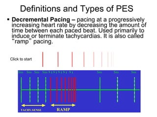 Definitions and Types of PES
 Decremental Pacing – pacing at a progressively
  increasing heart rate by decreasing the amount of
  time between each paced beat. Used primarily to
  induce or terminate tachycardias. It is also called
  “ramp” pacing.

    Click to start


         Sns Sns Sns Sns S 1 S 1 S 1 S 1 S 1   Sns   Sns   Sns




7         TACHY.SENSE            RAMP
 