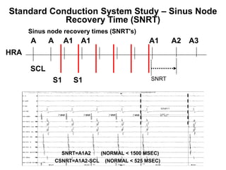 Standard Conduction System Study – Sinus Node
            Recovery Time (SNRT)
      Sinus node recovery times (SNRT's)
      A     A     A1    A1                       A1      A2   A3
HRA

      SCL
             S1        S1                         SNRT




                  SNRT=A1A2      (NORMAL < 1500 MSEC)
80              CSNRT=A1A2-SCL    (NORMAL < 525 MSEC)
 