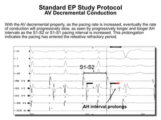 Standard EP Study Protocol
                      AV Decremental Conduction

With the AV decremental property, as the pacing rate is increased, eventually the rate
of conduction will progressively slow, as seen by progressively longer and longer AH
intervals as the S1-S2 or S1-S1 pacing interval is increased. This prolongation
indicates the pacing has entered the releative refractory period.




                                          S1-S2




                                            AH interval prolongs
 86
 