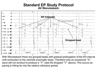 Standard EP Study Protocol
                                AV Wenckebach


                                   AH Intervals




                                                         Dropped beat




With Wenckebach there are grouped beats with gradual prolongation of the AH interval
until conduction to the ventricle eventually drops. Therefore only an occasional “A”
wave will not conduct to produce a “V” (see the dropped “V” above). This occurs as
pacing is hitting far into the relative refractory period.
 87
 