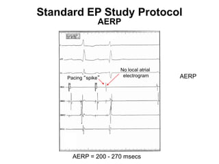 Standard EP Study Protocol
                       AERP




                           No local atrial
          Pacing “spike”    electrogram      AERP




90          AERP = 200 - 270 msecs
 