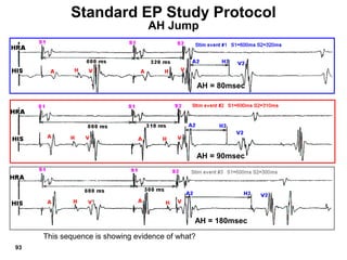 Standard EP Study Protocol
                                 AH Jump




                                                  AH = 80msec




                                                  AH = 90msec




                                              AH = 180msec

     This sequence is showing evidence of what?
93
 