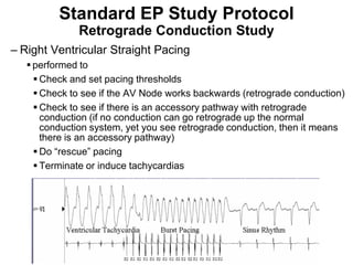 Standard EP Study Protocol
                Retrograde Conduction Study
– Right Ventricular Straight Pacing
      performed to
        Check and set pacing thresholds
        Check to see if the AV Node works backwards (retrograde conduction)
        Check to see if there is an accessory pathway with retrograde
         conduction (if no conduction can go retrograde up the normal
         conduction system, yet you see retrograde conduction, then it means
         there is an accessory pathway)
        Do “rescue” pacing
        Terminate or induce tachycardias




95
 