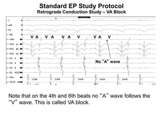 Standard EP Study Protocol
           Retrograde Conduction Study – VA Block




         V A    V A   V A   V      V A   V




                                   No “A” wave




Note that on the 4th and 6th beats no “A” wave follows the
“V” wave. This is called VA block.

97
 