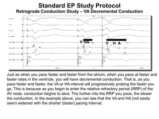 Standard EP Study Protocol
     Retrograde Conduction Study – VA Decremental Conduction




                                          V HA           V   H A




Just as when you pace faster and faster from the atrium, when you pace at faster and
faster rates in the ventricle, you will have decremental conduction. That is, as you
pace faster and faster, the VA or HA interval will progressively prolong the faster you
go. This is because as you begin to enter the relative refractory period (RRP) of the
AV node, conduction begins to slow. The further into the RRP you pace, the slower
the conduction. In the example above, you can see that the VA and HA (not easily
seen) widened with the shorter (faster) pacing interval.

98
 
